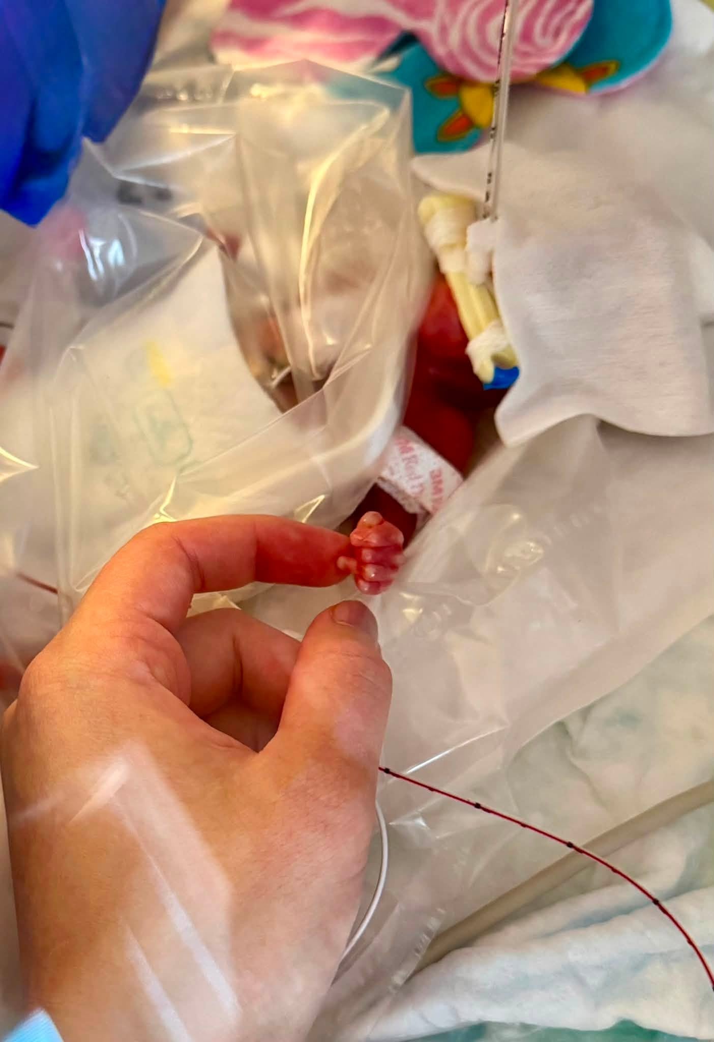 Preemie Born at 23 Weeks Graduates NICU After 375 Days