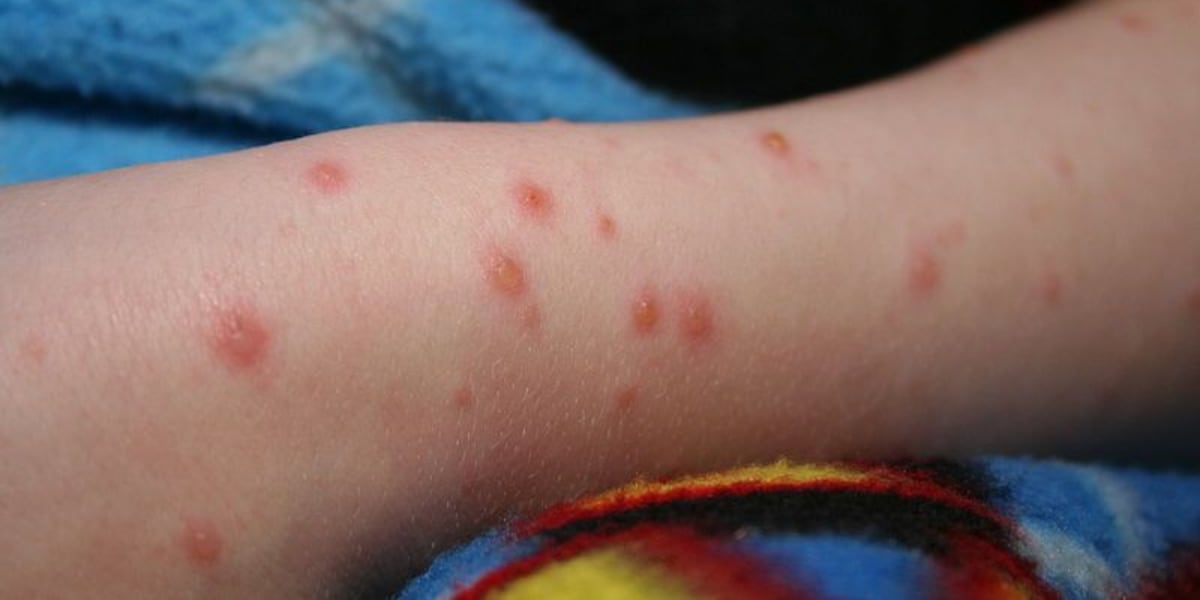 Checkpox Chickenpox outbreak reported at Upstate school