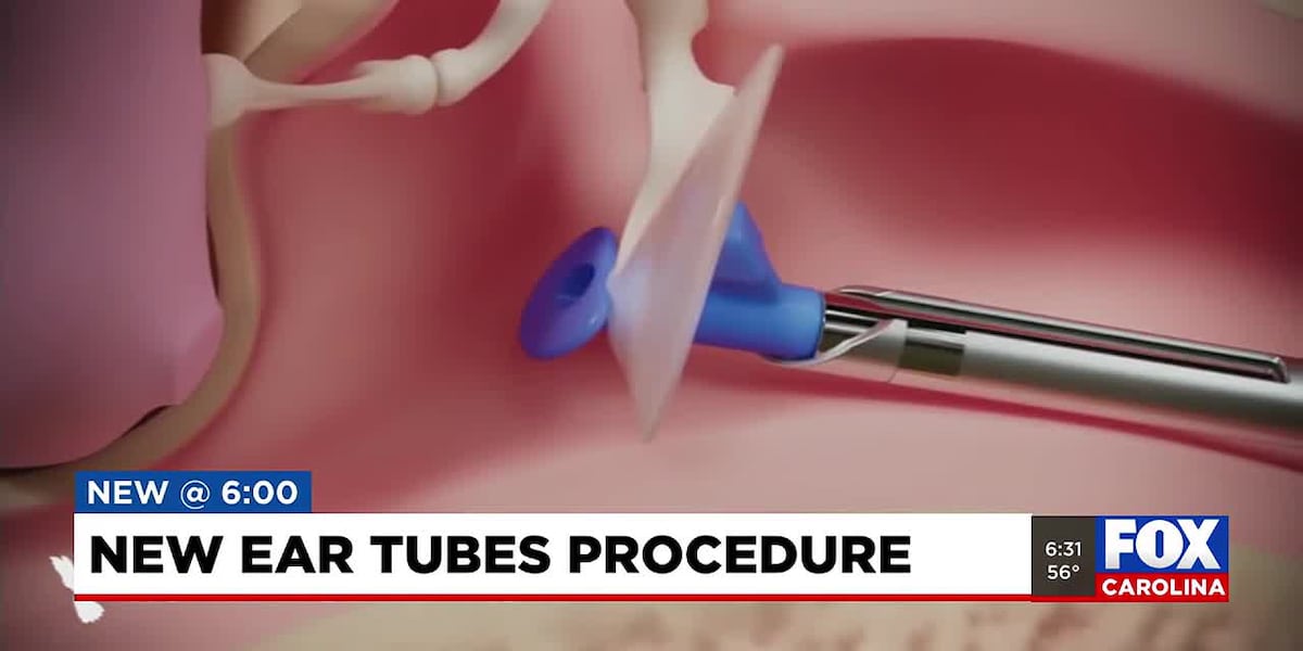 New Ear Tube Procedure For Children Can Be Done In Five Minutes new-ear-tube-procedure-for-children-can-be-done-in-five-minutes