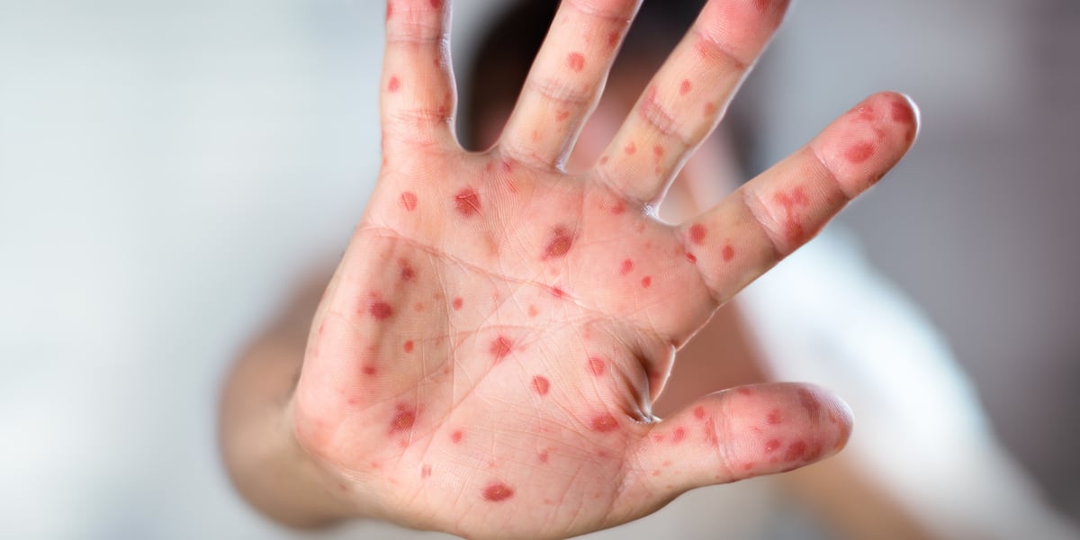 Photo: foxcarolina.com Measles Exposure Warning Issued for Hotel Guests by NCDPH